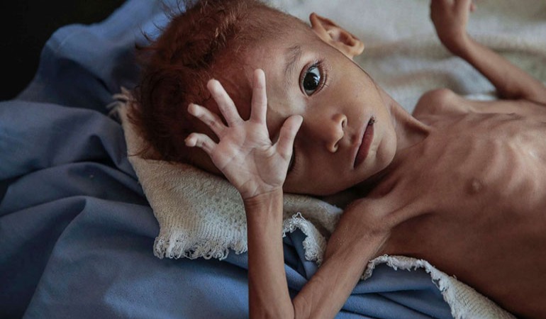 Bm: Yemen’de milyonlarca çocuk açlıkla boğuşuyor